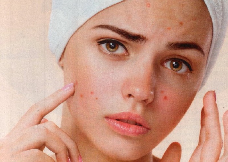 Menstruacija i akne – kako su te dvije stvari povezane?