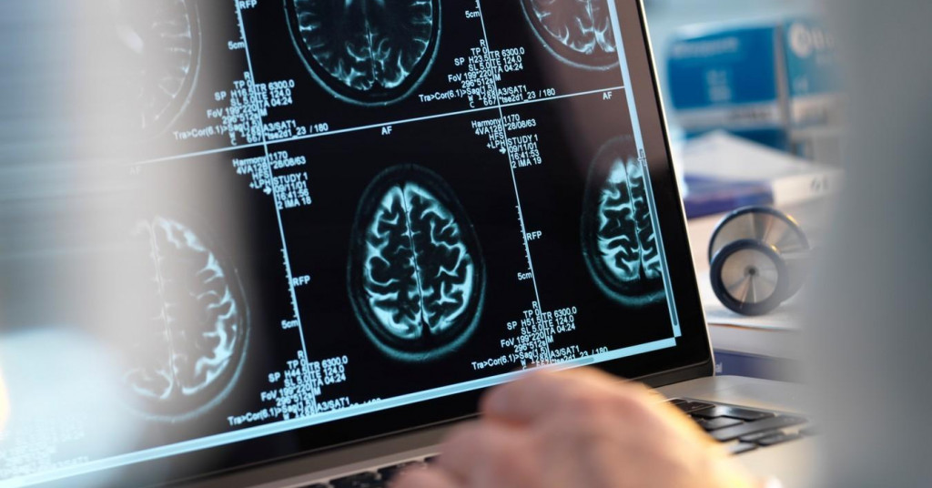 Otvara nam se mogućnost da stvorimo cjepivo protiv Alzheimera