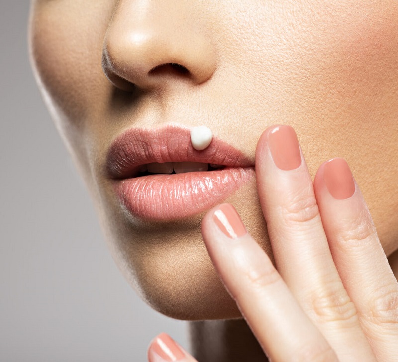 Herpes na usni – kako se prenosi i kako ublažiti simptome?