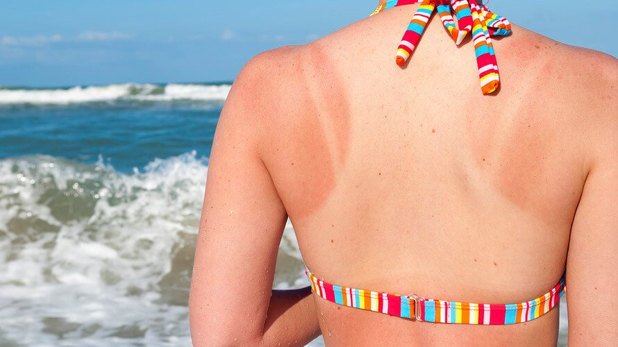 Kad te sunce ‘opali’ – kako pravilno tretirati opekline?