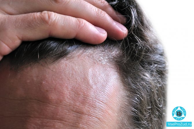 Seboreja – simptomi i kako ju izliječiti na prirodan način