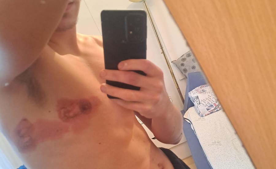 Otvorena istraga protiv policajca i kolege mu zbog paljenja bakljom mladića iz Širokog Brijega